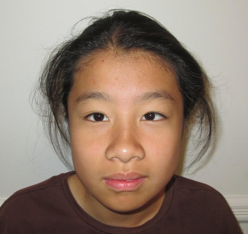 Esotropia Before & After Gallery - Patient 662544 - Image 1
