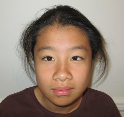 Esotropia Before & After Gallery - Patient 662544 - Image 1
