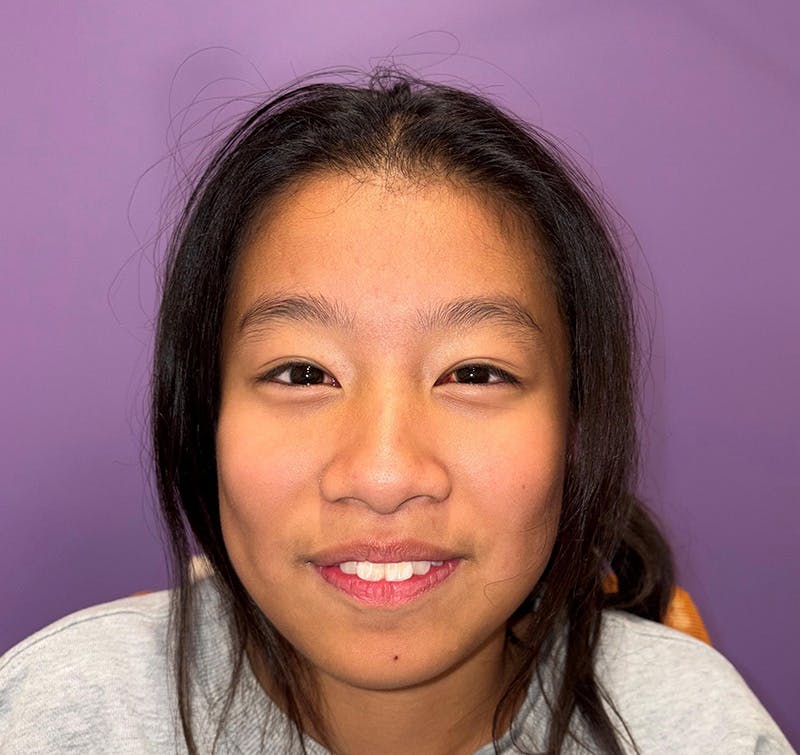 Esotropia Before & After Gallery - Patient 662544 - Image 2