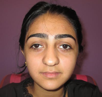 Exotropia Before & After Gallery - Patient 255612 - Image 1