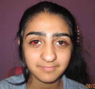 Exotropia Before & After Gallery - Patient 255612 - Image 2
