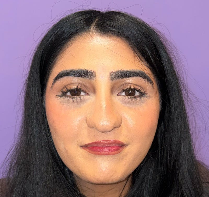 Exotropia Before & After Gallery - Patient 255612 - Image 4