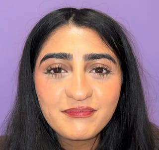 Exotropia Before & After Gallery - Patient 255612 - Image 4