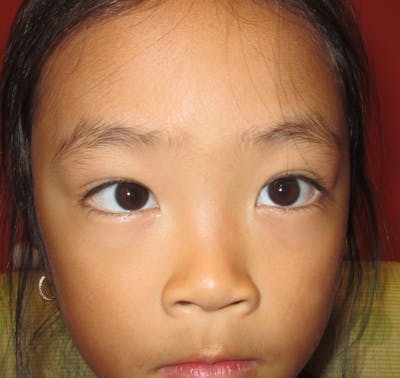 Esotropia Before & After Gallery - Patient 704572 - Image 1