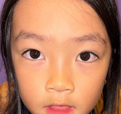 Esotropia Before & After Gallery - Patient 704572 - Image 2