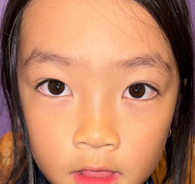 Esotropia Before & After Gallery - Patient 704572 - Image 2