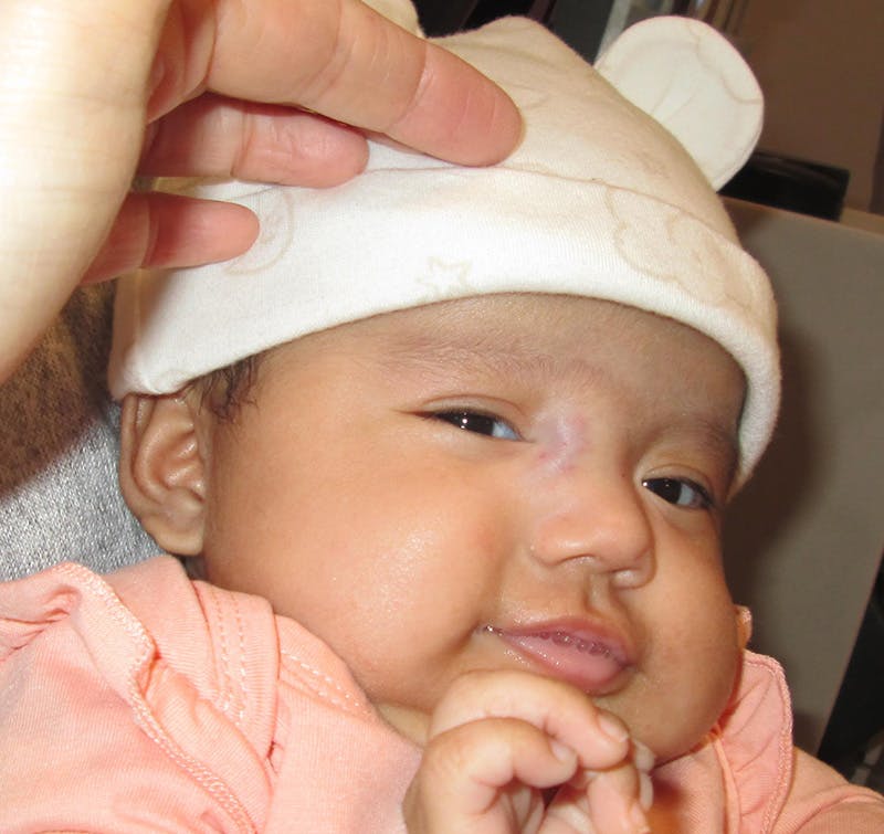 Capillary Hemangioma Before & After Gallery - Patient 600686 - Image 1