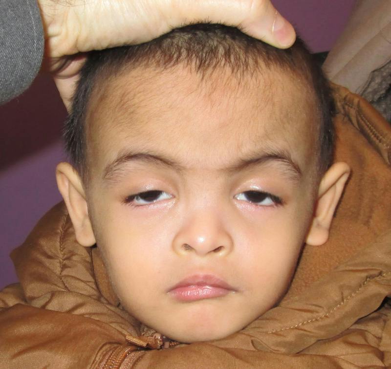 Ptosis Before & After Gallery - Patient 121703 - Image 1