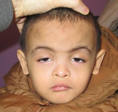 Ptosis Before & After Gallery - Patient 121703 - Image 1