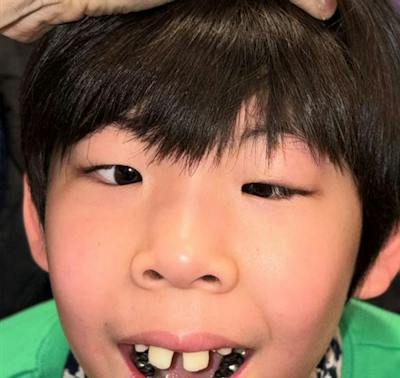 Complex Strabismus Before & After Gallery - Patient 161880 - Image 1