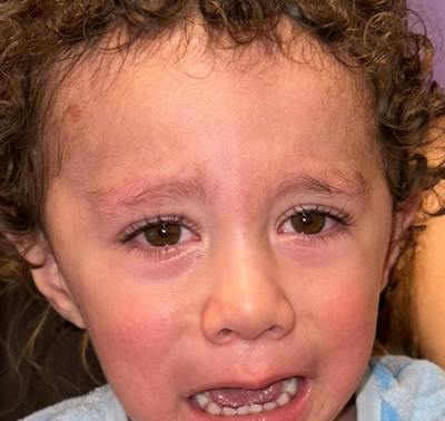 Esotropia Before & After Gallery - Patient 297425 - Image 1