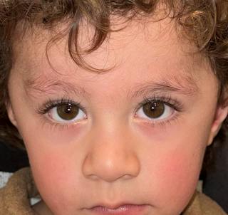 Esotropia Before & After Gallery - Patient 297425 - Image 4