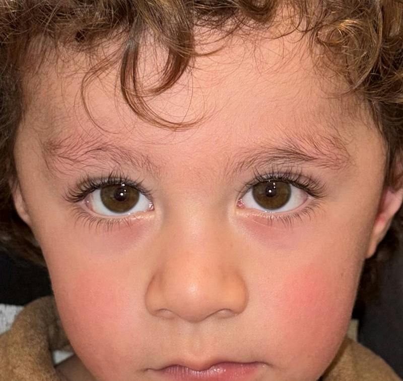 Esotropia Before & After Gallery - Patient 297425 - Image 4