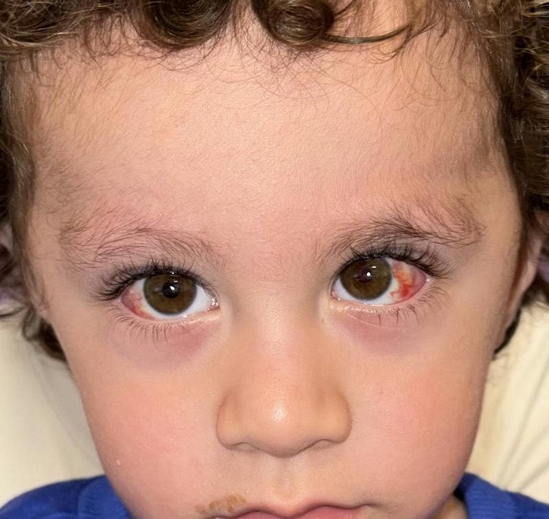 Esotropia Before & After Gallery - Patient 297425 - Image 2