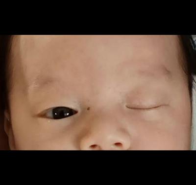 Ptosis Before & After Gallery - Patient 333437 - Image 1