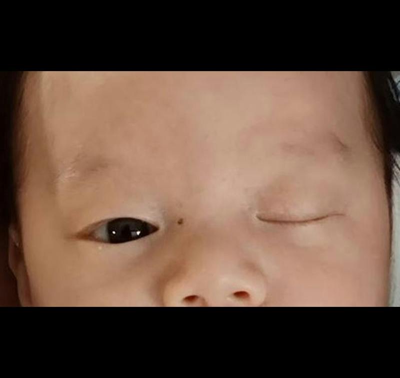 Ptosis Before & After Gallery - Patient 333437 - Image 1