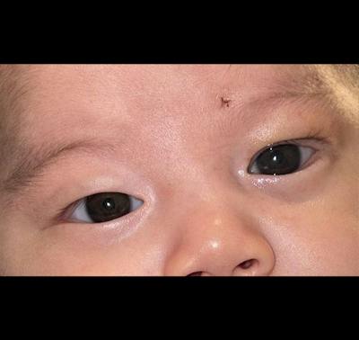 Ptosis Before & After Gallery - Patient 333437 - Image 2