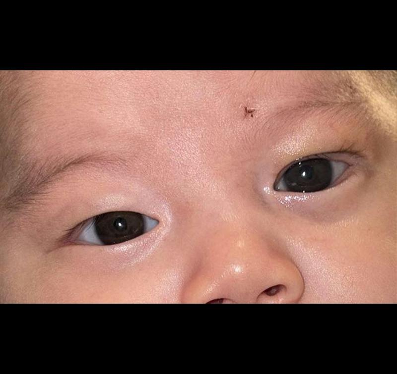 Ptosis Before & After Gallery - Patient 333437 - Image 2