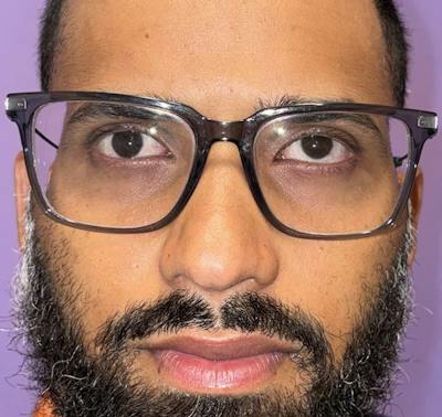 Complex Strabismus Before & After Gallery - Patient 175110 - Image 1
