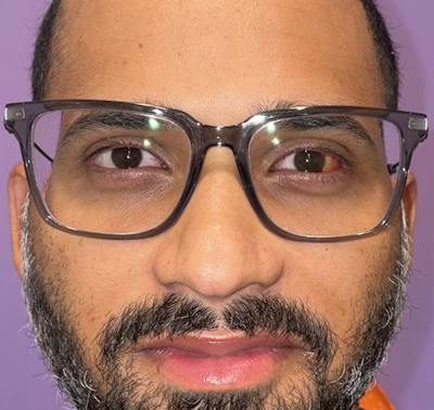 Complex Strabismus Before & After Gallery - Patient 175110 - Image 2