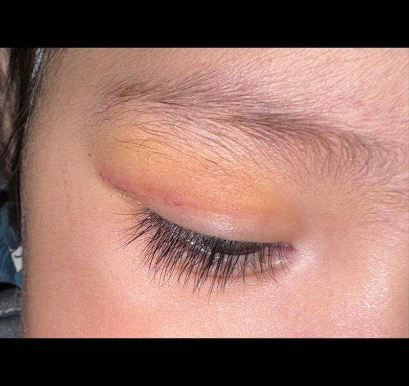 Dermoid Before & After Gallery - Patient 109763 - Image 2