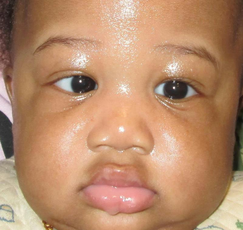 Esotropia Before & After Gallery - Patient 328595 - Image 1