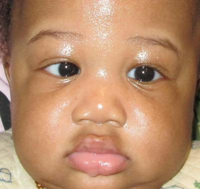 Esotropia Before & After Gallery - Patient 328595 - Image 1