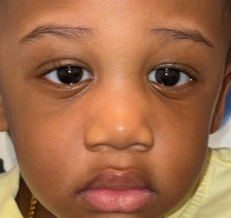 Esotropia Before & After Gallery - Patient 328595 - Image 2