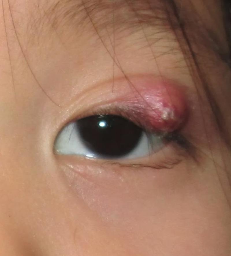 Chalazion Before & After Gallery - Patient 203461 - Image 1