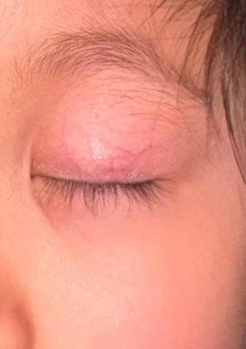 Chalazion Before & After Gallery - Patient 203461 - Image 2