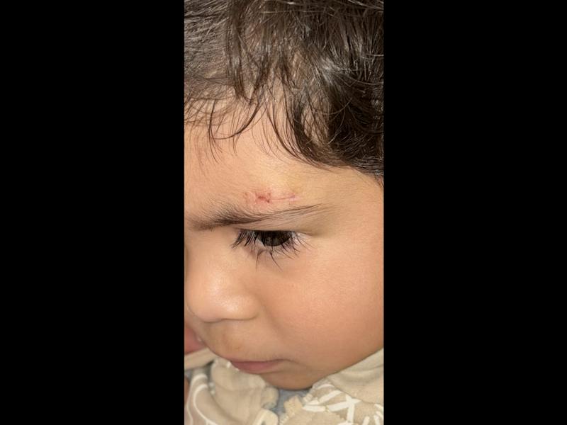 Dermoid Before & After Gallery - Patient 371957 - Image 2