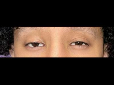 Ptosis Before & After Gallery - Patient 104873 - Image 1
