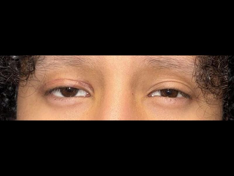 Ptosis Before & After Gallery - Patient 104873 - Image 2