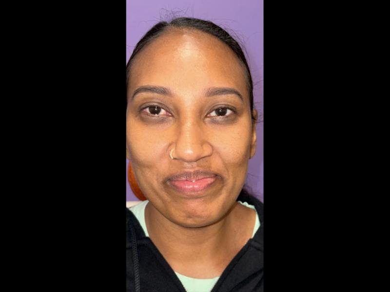 Esotropia Before & After Gallery - Patient 264072 - Image 2