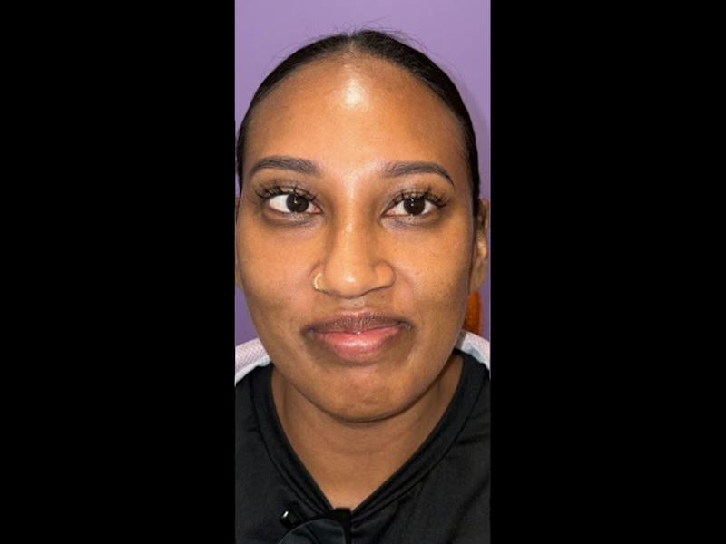 Esotropia Before & After Gallery - Patient 264072 - Image 1