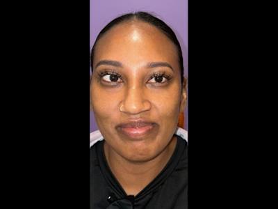 Esotropia Before & After Gallery - Patient 264072 - Image 1