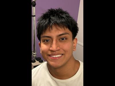 Nystagmus Before & After Gallery - Patient 213180 - Image 2