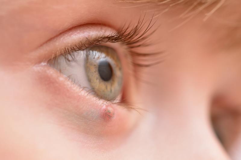 Close-up of a child's eye with a small chalazion bump on the lower eyelid