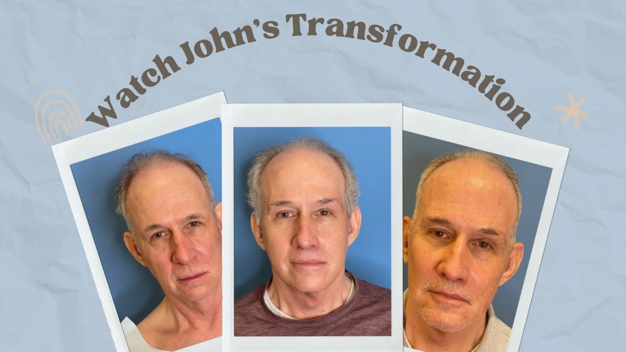 John's facelift transformation