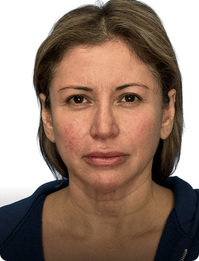 Before image of a woman