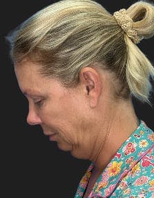 Patient 1, Before number 6