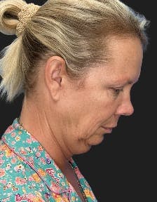 Patient 1, Before number 4