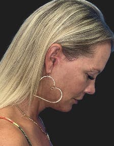 Patient 1, After number 4