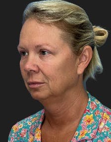 Patient 1, Before number 5