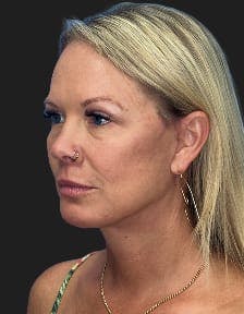 Patient 1, After number 5