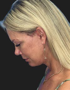 Patient 1, After number 6