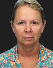 Patient 1, Before number 1