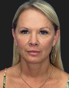 Patient 1, After number 1