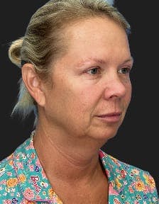 Patient 1, Before number 2