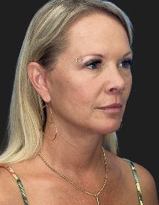 Patient 1, After number 2